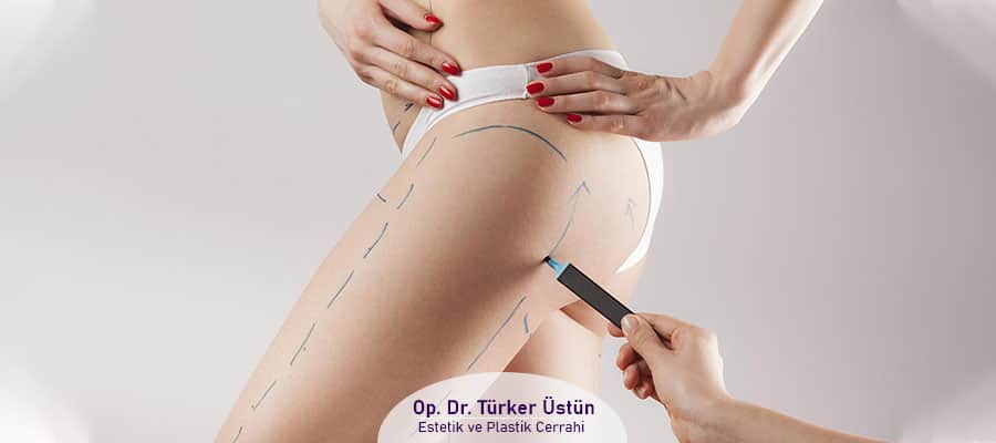 liposuction
